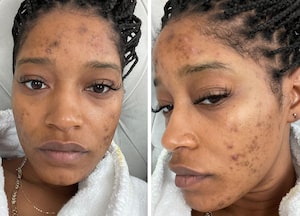 Keke Palmer Reveals Tyler Perry Helped Pay For a Dermatologist