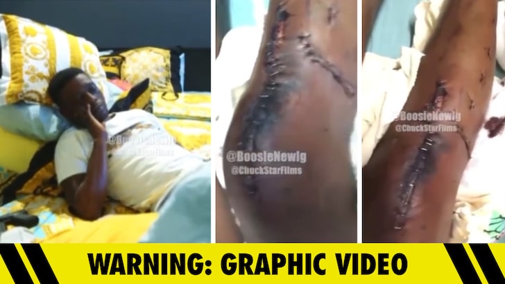 Boosie Badazz Reveals Gruesome Gunshot Injuries to Leg