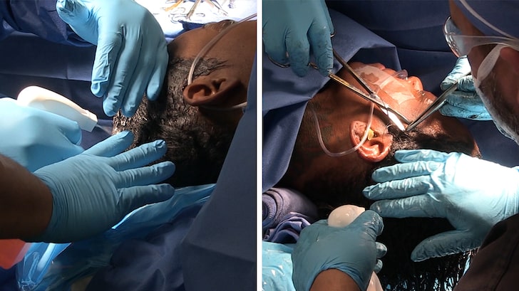 Tessica Brown Gets Gorilla Glue Out of Hair, Video of Surgery