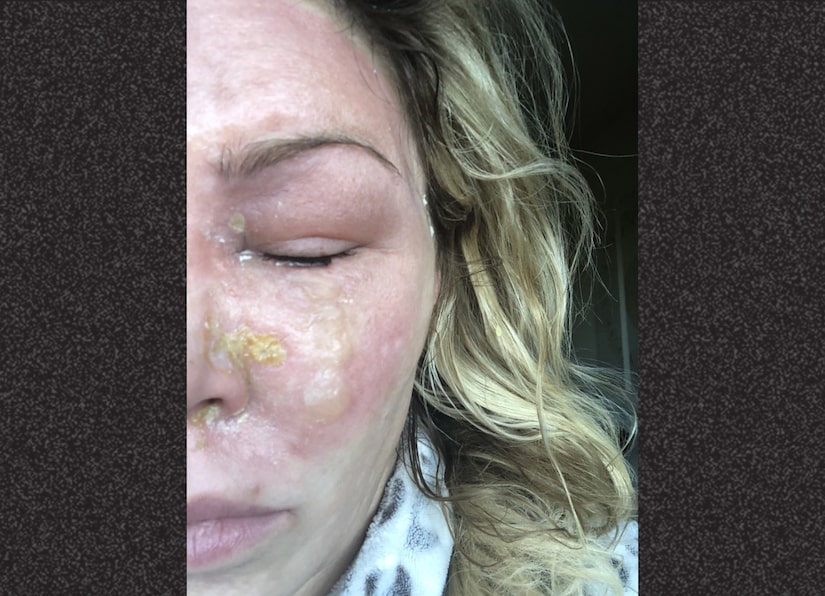 Brandi Glanville Shares Photo Of 2nd Degree Burns On Her Face From 'Accident With Psoriasis Light'