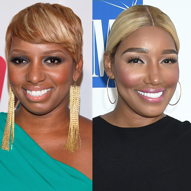 NeNe Leakes before & after plastic surgery